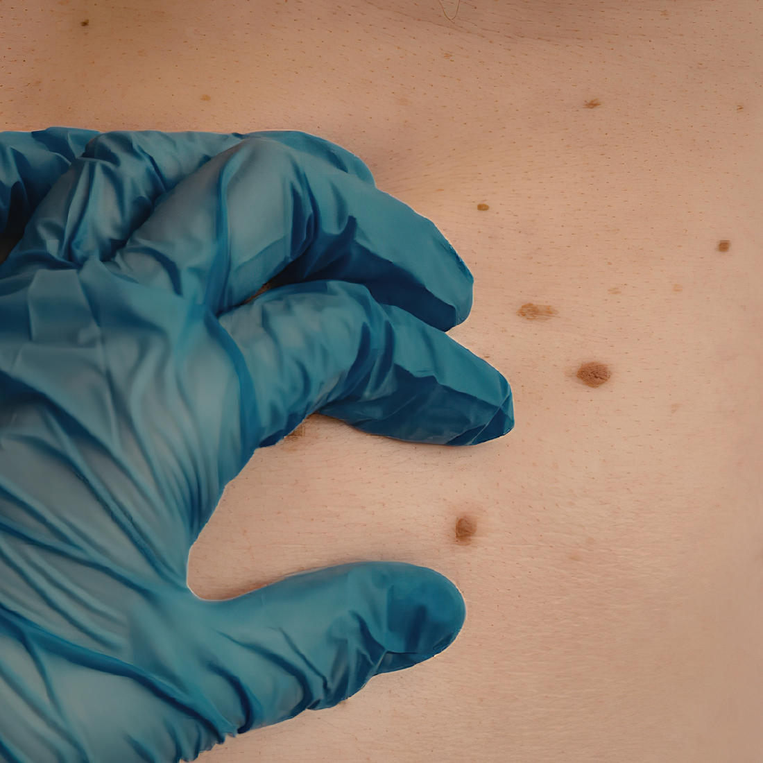 Hautscreening